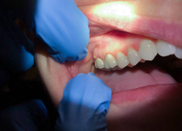 Best Broken or Cracked Tooth Emergency Dentist in Valley Cottage, NY